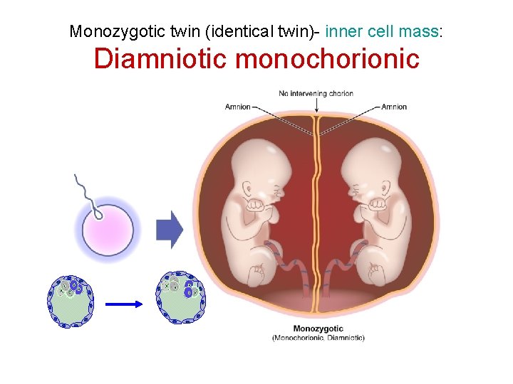 Monozygotic twin (identical twin)- inner cell mass: Diamniotic monochorionic 
