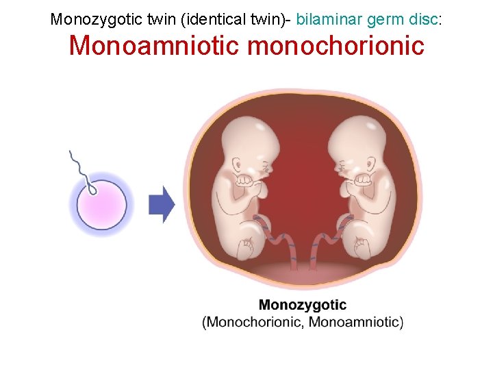 Monozygotic twin (identical twin)- bilaminar germ disc: Monoamniotic monochorionic 
