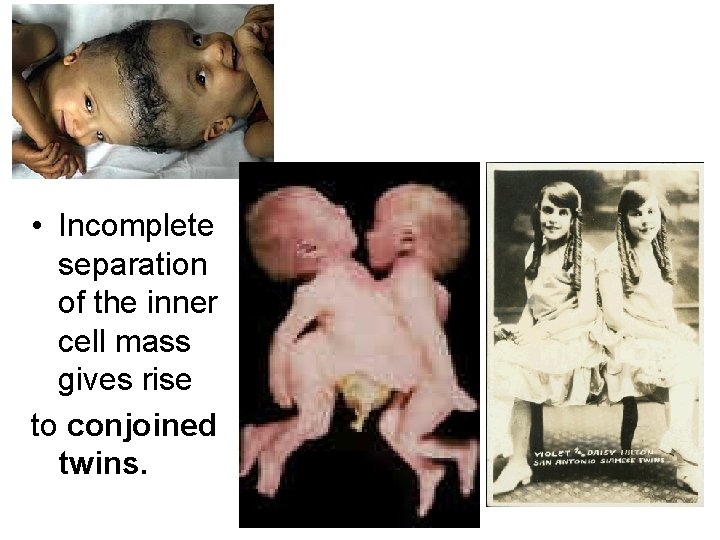  • Incomplete separation of the inner cell mass gives rise to conjoined twins.