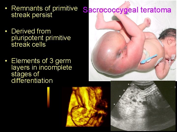  • Remnants of primitive Sacrococcygeal teratoma streak persist • Derived from pluripotent primitive
