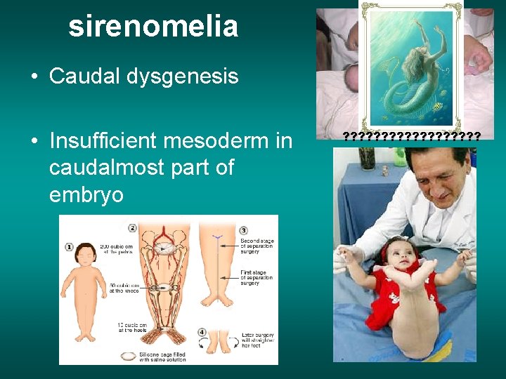 sirenomelia • Caudal dysgenesis • Insufficient mesoderm in caudalmost part of embryo ? ?