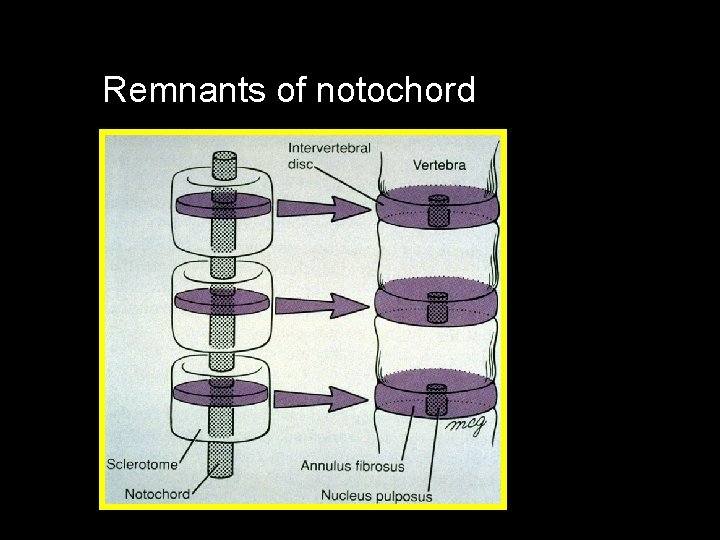 Remnants of notochord 