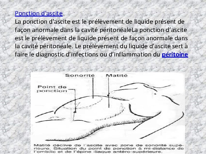 Ponction d'ascite La ponction d'ascite est le prélèvement de liquide présent de façon anormale