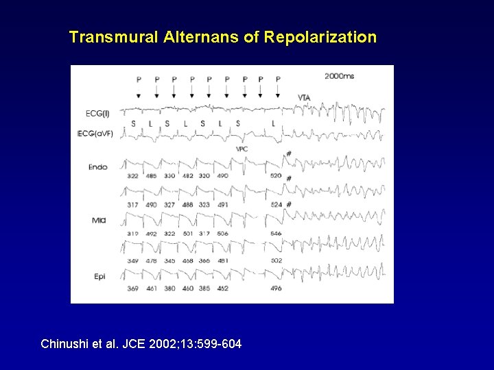Transmural Alternans of Repolarization Chinushi et al. JCE 2002; 13: 599 -604 