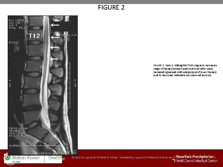 FIGURE 2. Case 1. Midsagittal T 2 WI magnetic resonance image of thoracolumbar spinal