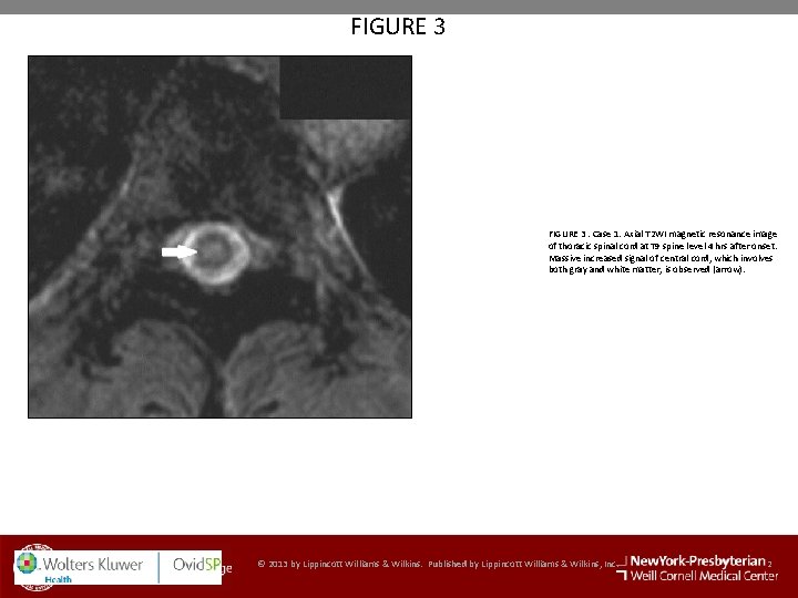 FIGURE 3. Case 1. Axial T 2 WI magnetic resonance image of thoracic spinal
