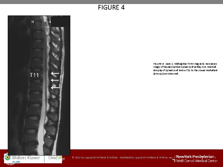 FIGURE 4. Case 1. Midsagittal T 2 WI magnetic resonance image of thoracolumbar spinal