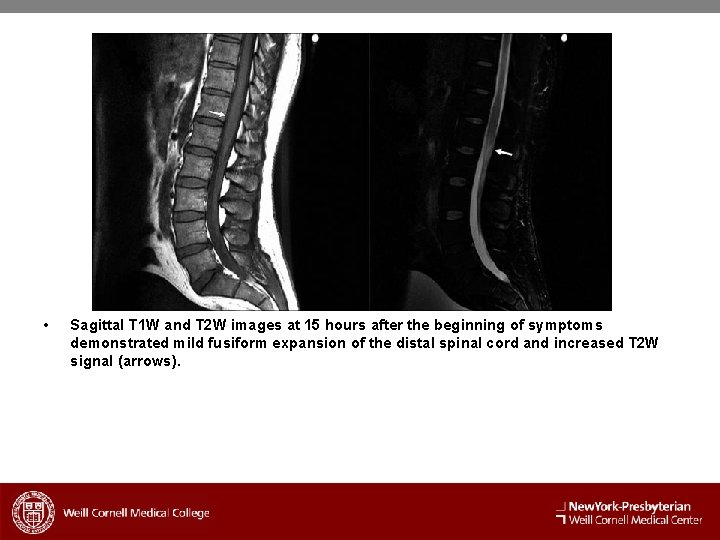  • Sagittal T 1 W and T 2 W images at 15 hours