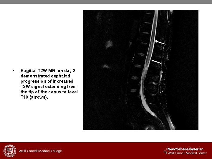  • Sagittal T 2 W MRI on day 2 demonstrated cephalad progression of