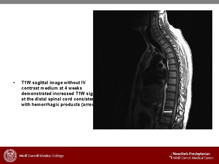  • T 1 W sagittal image without IV contrast medium at 4 weeks