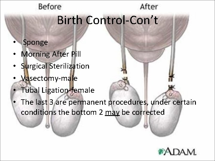 Birth Control-Con’t • • • Sponge Morning After Pill Surgical Sterilization Vasectomy-male Tubal Ligation-female