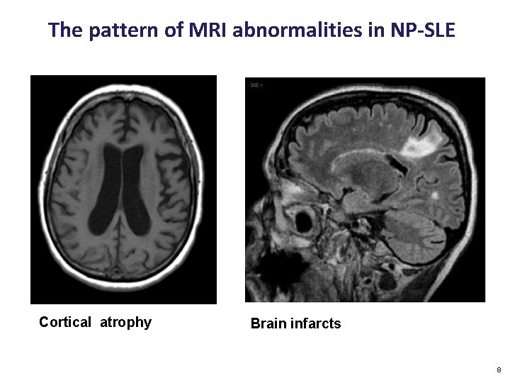 The pattern of MRI abnormalities in NP-SLE Cortical atrophy Brain infarcts 8 