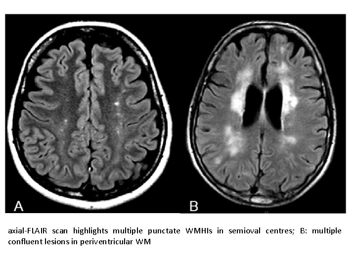 axial-FLAIR scan highlights multiple punctate WMHIs in semioval centres; B: multiple confluent lesions in