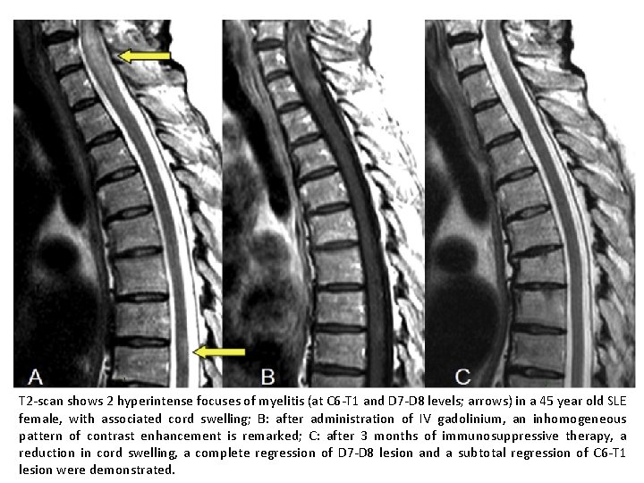 T 2 -scan shows 2 hyperintense focuses of myelitis (at C 6 -T 1