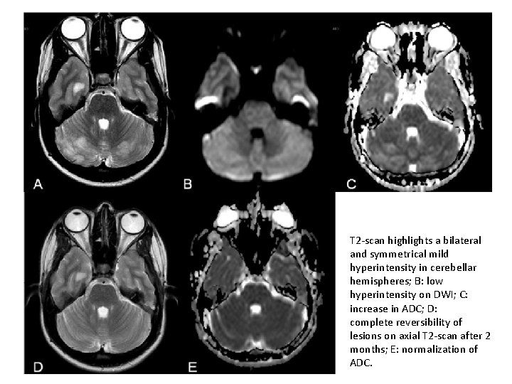 T 2 -scan highlights a bilateral and symmetrical mild hyperintensity in cerebellar hemispheres; B: