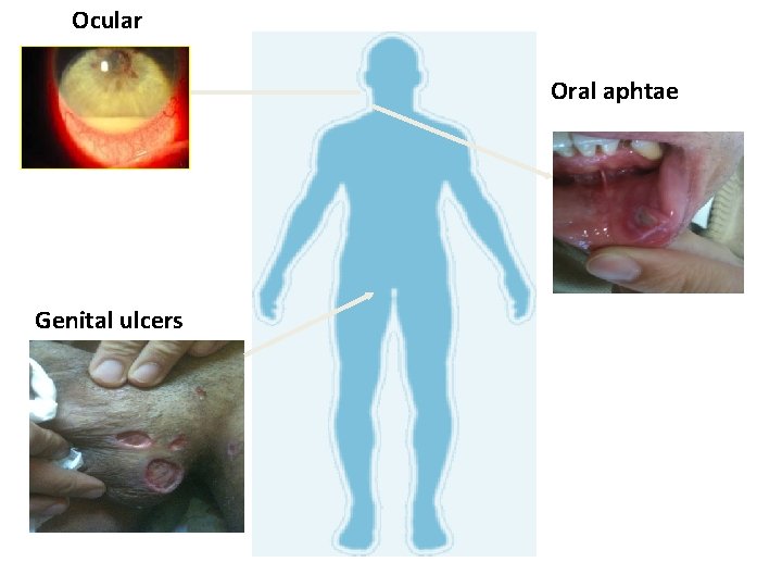  Ocular Oral aphtae Genital ulcers 