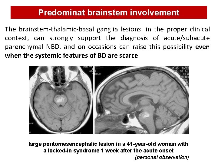 Predominat brainstem involvement The brainstem-thalamic-basal ganglia lesions, in the proper clinical context, can strongly