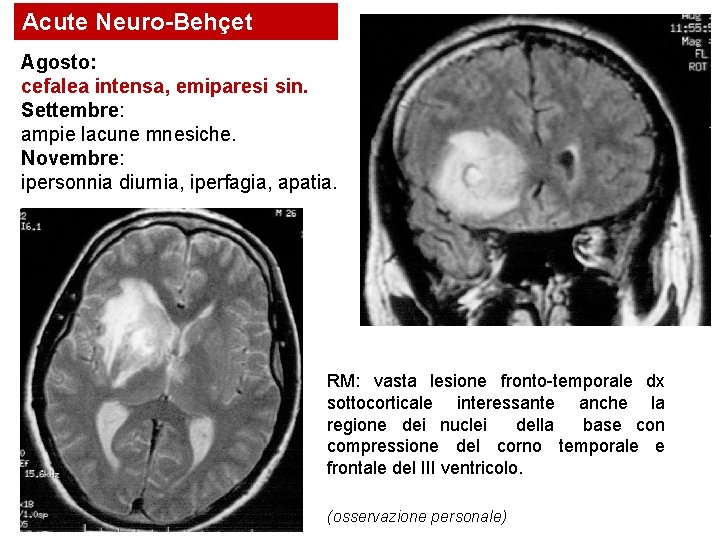 Acute Neuro-Behçet Agosto: cefalea intensa, emiparesi sin. Settembre: ampie lacune mnesiche. Novembre: ipersonnia diurnia,