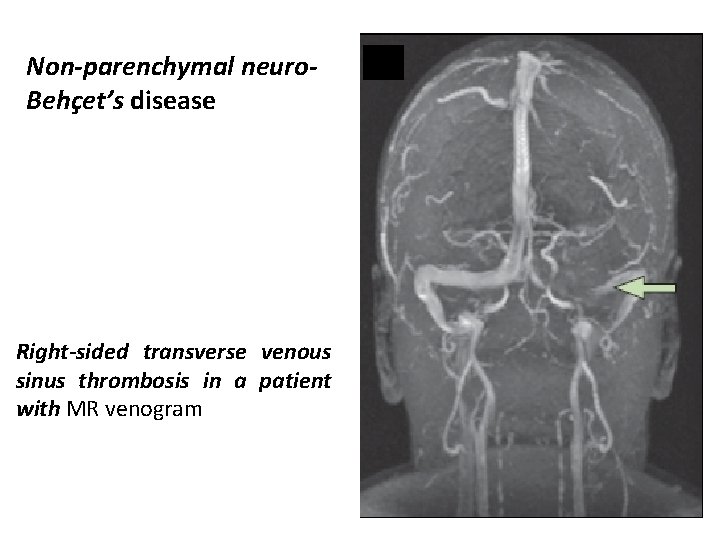 Non-parenchymal neuro. Behçet’s disease Right-sided transverse venous sinus thrombosis in a patient with MR
