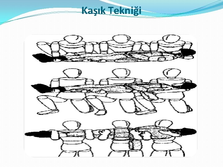 Kaşık Tekniği 