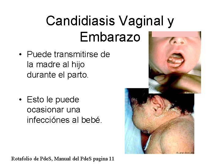 Candidiasis Vaginal y Embarazo • Puede transmitirse de la madre al hijo durante el