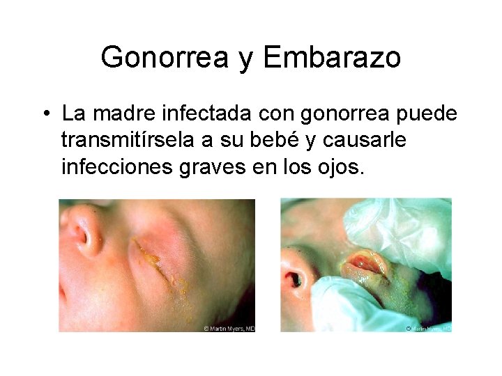 Gonorrea y Embarazo • La madre infectada con gonorrea puede transmitírsela a su bebé