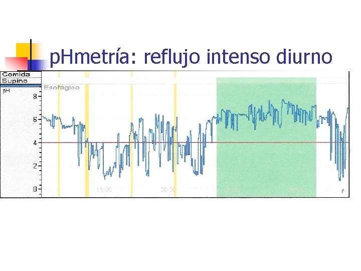 p. Hmetría: reflujo intenso diurno 