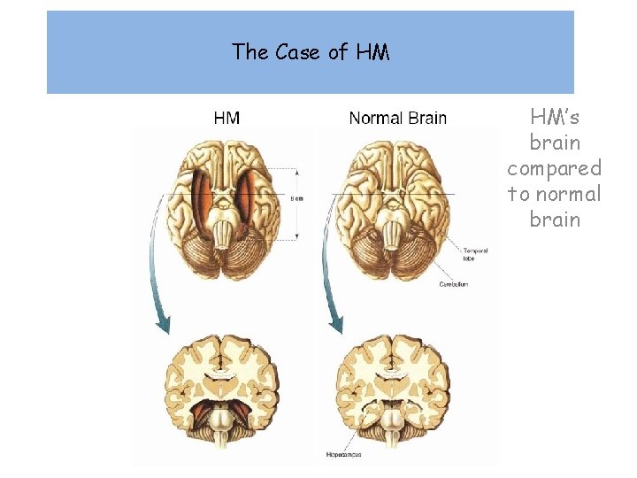 The Case of HM HM’s brain compared to normal brain 