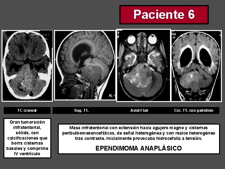 Paciente 6 TC craneal Gran tumoración infratentorial, sólida, con calcificaciones que borra cisternas basales