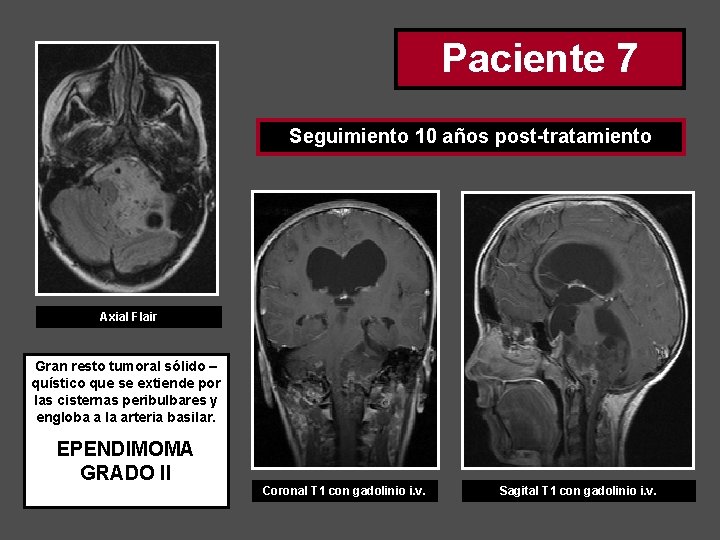 Paciente 7 Seguimiento 10 años post-tratamiento Axial Flair Gran resto tumoral sólido – quístico