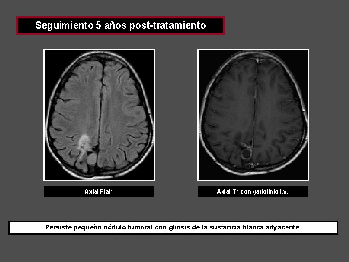 Seguimiento 5 años post-tratamiento Axial Flair Axial T 1 con gadolinio i. v. Persiste