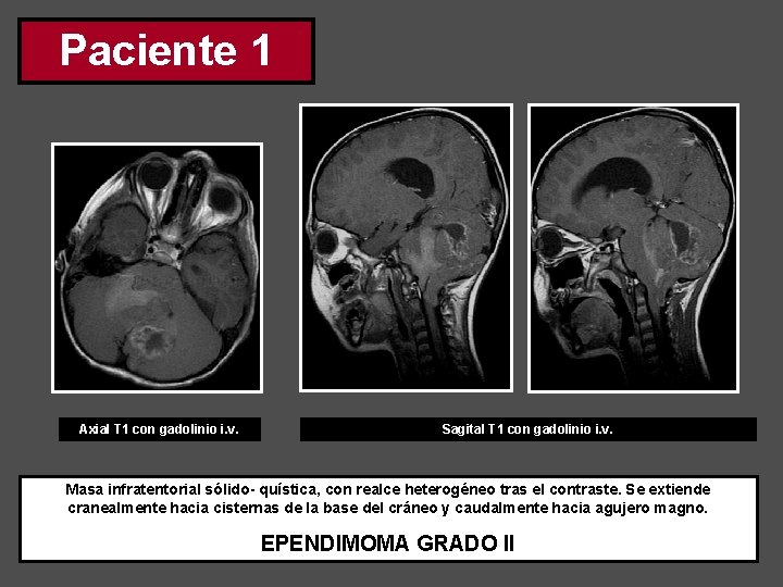 Paciente 1 Axial T 1 con gadolinio i. v. Sagital T 1 con gadolinio