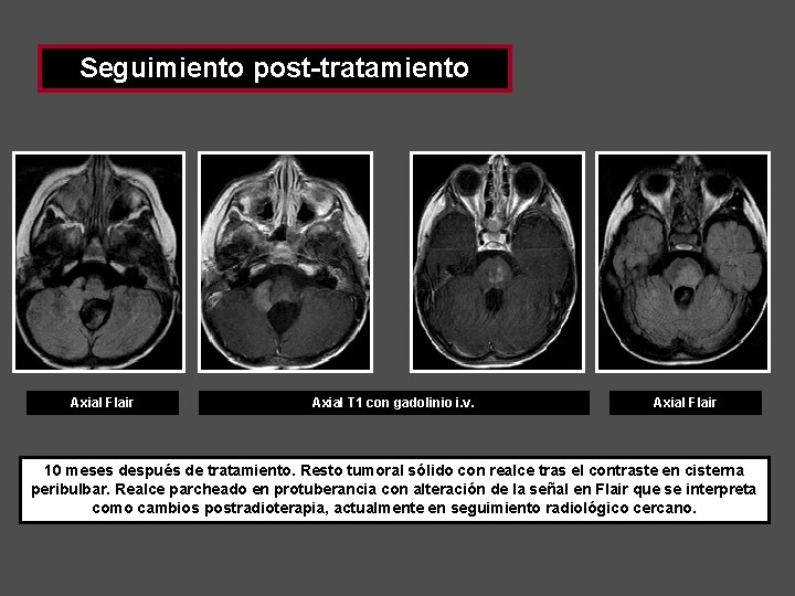 Seguimiento post-tratamiento Axial Flair Axial T 1 con gadolinio i. v. Axial Flair 10