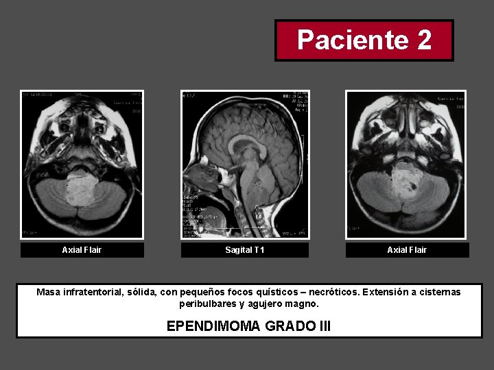 Paciente 2 Axial Flair Sagital T 1 Axial Flair Masa infratentorial, sólida, con pequeños