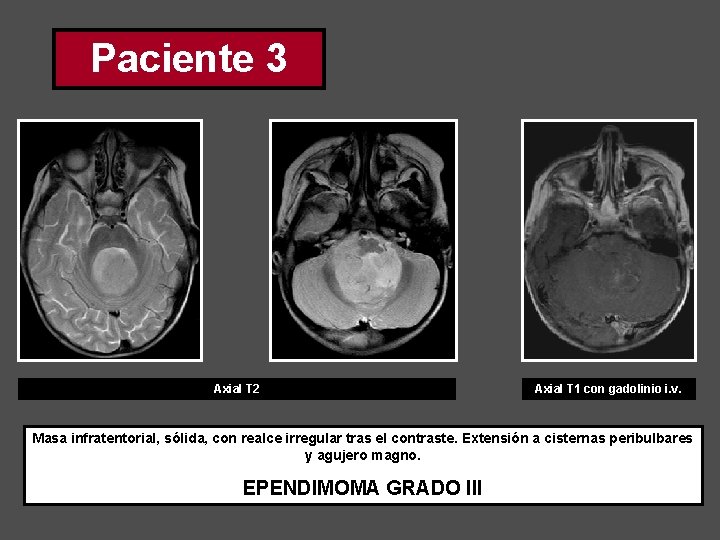 Paciente 3 Axial T 2 Axial T 1 con gadolinio i. v. Masa infratentorial,