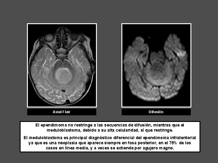 Axial Flair Difusión El ependimoma no restringe a las secuencias de difusión, mientras que