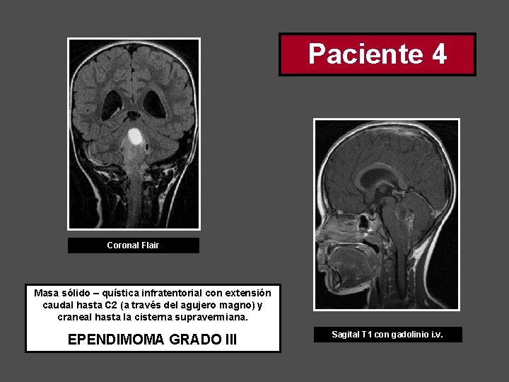 Paciente 4 Coronal Flair Masa sólido – quística infratentorial con extensión caudal hasta C