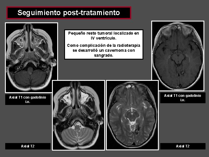 Seguimiento post-tratamiento Pequeño resto tumoral localizado en IV ventrículo. Como complicación de la radioterapia Seguimiento post-tratamiento Pequeño resto tumoral localizado en IV ventrículo. Como complicación de la radioterapia