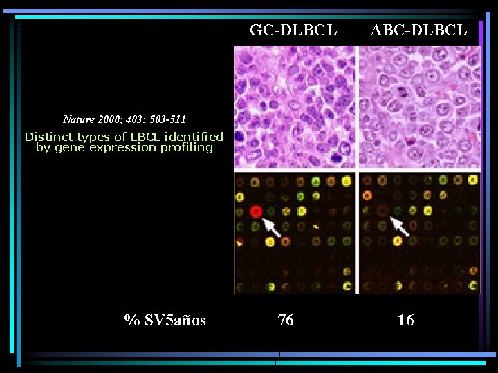 GC-DLBCL ABC-DLBCL Nature 2000; 403: 503 -511 Distinct types of LBCL identified by gene