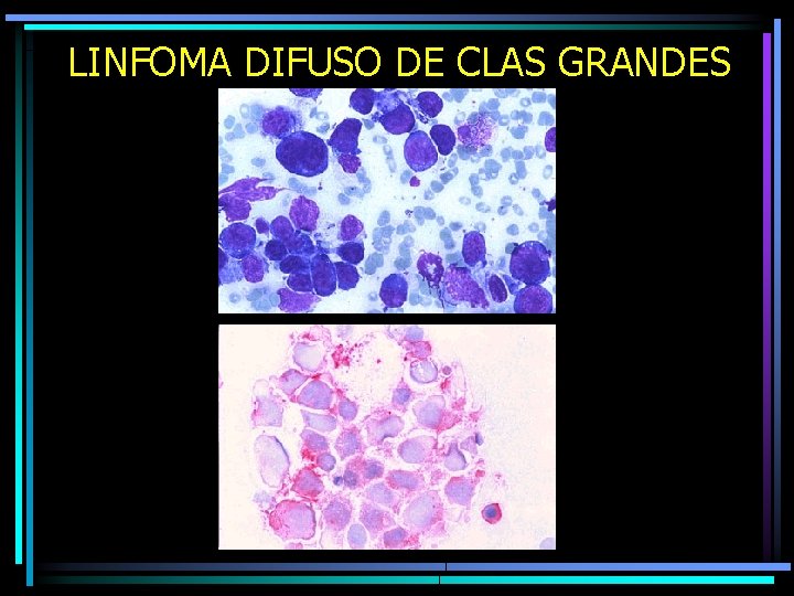 LINFOMA DIFUSO DE CLAS GRANDES 