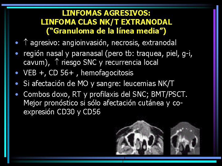 LINFOMAS AGRESIVOS: LINFOMA CLAS NK/T EXTRANODAL (“Granuloma de la línea media”) • agresivo: angioinvasión,