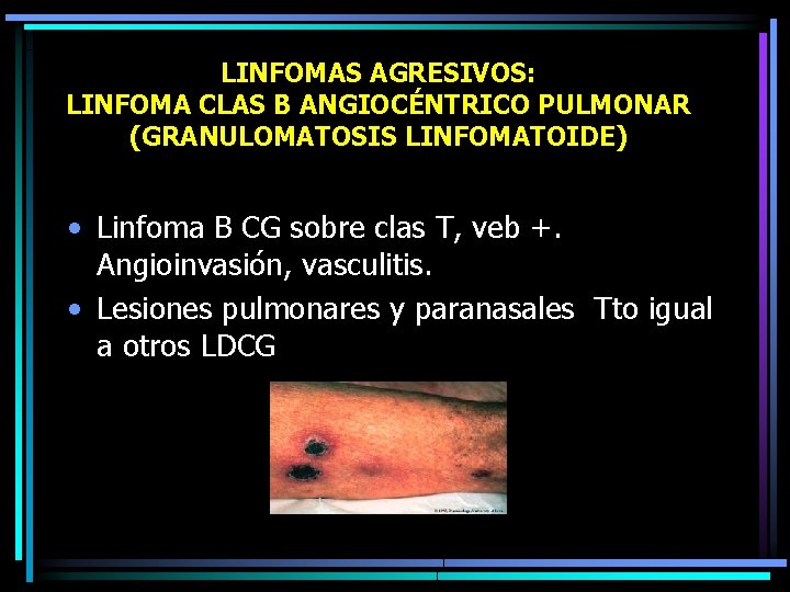LINFOMAS AGRESIVOS: LINFOMA CLAS B ANGIOCÉNTRICO PULMONAR (GRANULOMATOSIS LINFOMATOIDE) • Linfoma B CG sobre