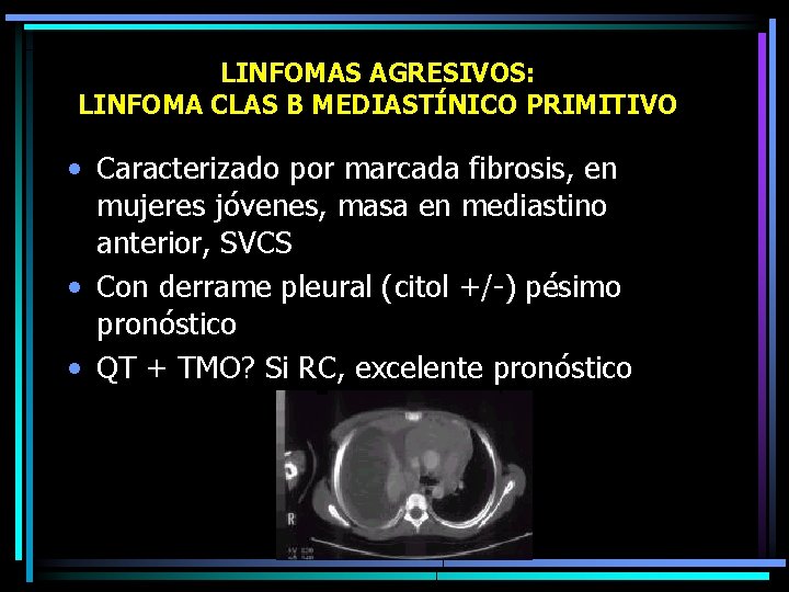 LINFOMAS AGRESIVOS: LINFOMA CLAS B MEDIASTÍNICO PRIMITIVO • Caracterizado por marcada fibrosis, en mujeres