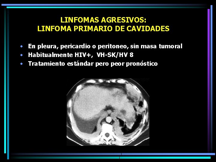 LINFOMAS AGRESIVOS: LINFOMA PRIMARIO DE CAVIDADES • En pleura, pericardio o peritoneo, sin masa