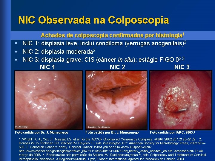 papilloma virus colposcopia