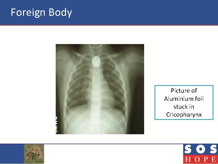 Foreign Body Picture of Aluminium foil stuck in Cricopharynx 