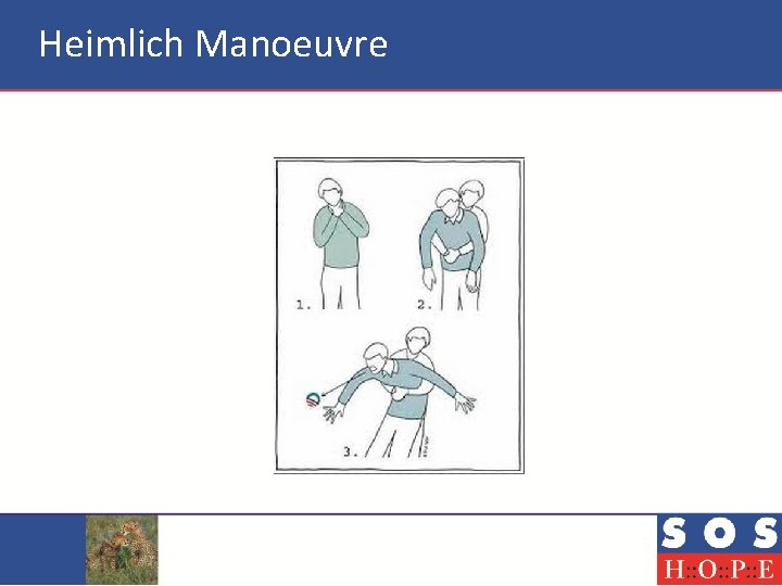 Heimlich Manoeuvre 