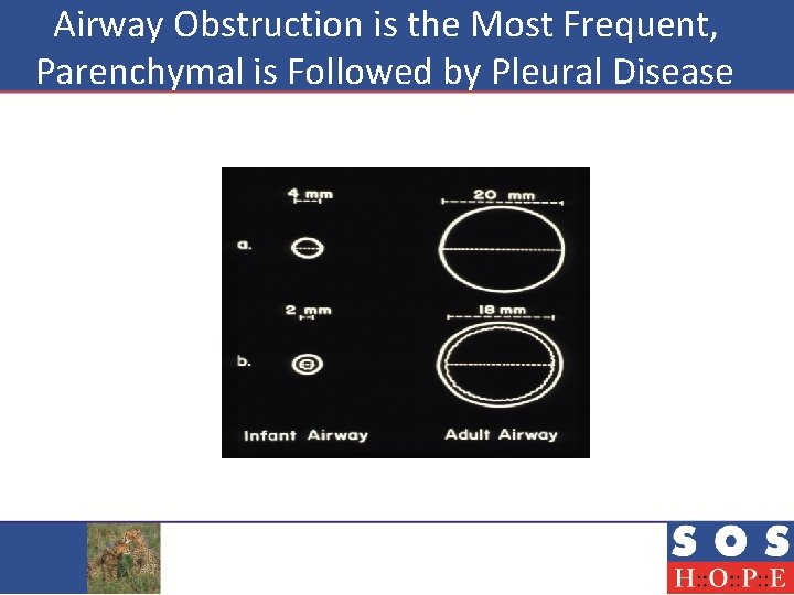  Airway Obstruction is the Most Frequent, Parenchymal is Followed by Pleural Disease 