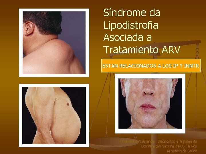 Síndrome da Lipodistrofia Asociada a Tratamiento ARV ESTAN RELACIONADOS A LOS IP Y INNTR