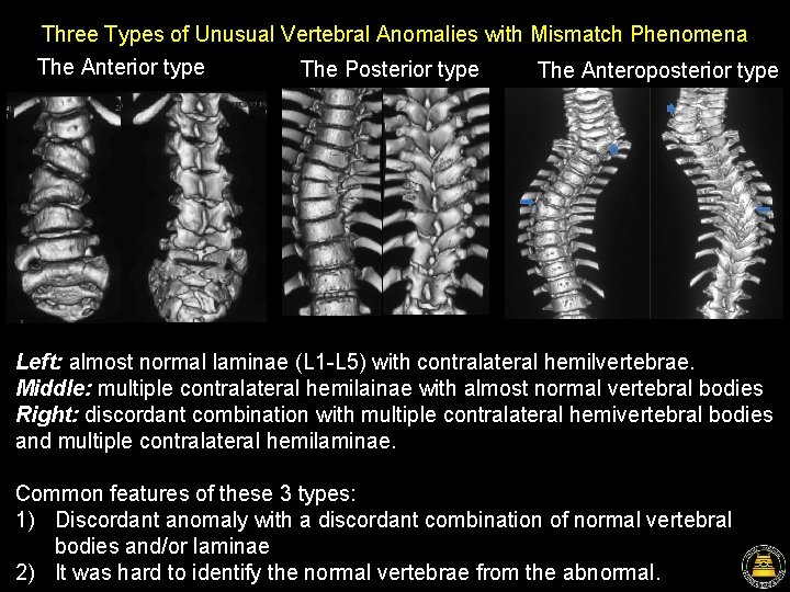 Three Types of Unusual Vertebral Anomalies with Mismatch Phenomena The Anterior type The Posterior